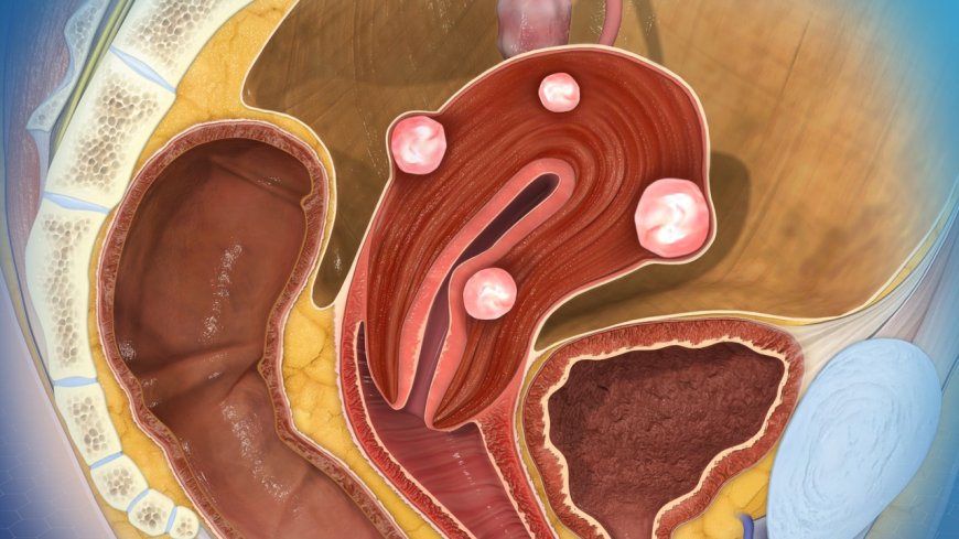 கருப்பை நார்த்திசுக்கட்டிகளை (Fibroids) அகற்றியே தீர வேண்டுமா?